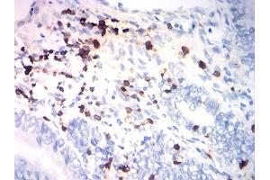 Immunohistochemical analysis of paraffin-embedded endometrial cancer tissues using CD7 mouse mAb with DAB staining. (CD7 Antikörper  (AA 26-180))