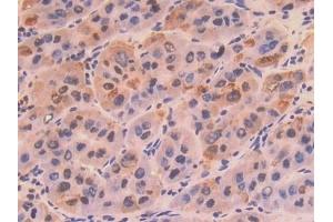 Detection of COL8a1 in Human Liver cancer Tissue using Polyclonal Antibody to Collagen Type VIII Alpha 1 (COL8a1) (COL8A1 Antikörper  (AA 575-743))