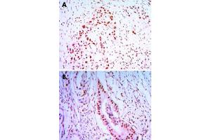Immunohistochemical analysis of paraffin-embedded human lung cancer tissues (A) and colon cancer tissues (B) using CDC27 monoclonal antibody, clone 5C12  with DAB staining. (CDC27 Antikörper)