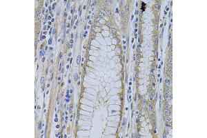 Immunohistochemistry of paraffin-embedded human gastric cancer using MVP Antibody.