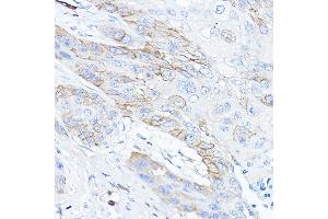 Immunohistochemistry of paraffin-embedded human esophageal cancer using TMPRSS2 Rabbit pAb (ABIN6132728, ABIN6149286, ABIN6149287 and ABIN6219138) at dilution of 1:50 (40x lens). (TMPRSS2 Antikörper  (AA 140-400))
