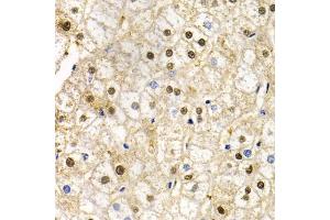 Immunohistochemistry of paraffin-embedded human liver injury using RAD9A antibody (ABIN5970971) at dilution of 1/200 (40x lens).