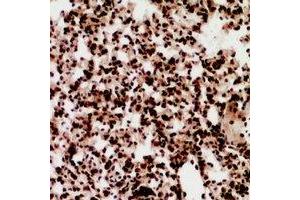 Immunohistochemical analysis of ZNF600 staining in human lung cancer formalin fixed paraffin embedded tissue section. (ZNF600 Antikörper)