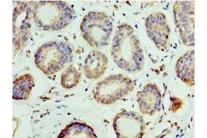 Immunohistochemistry of paraffin-embedded human breast cancer using ABIN7151101 at dilution of 1:100 (Pellino 1 Antikörper  (AA 1-250))