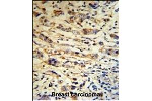 A1BG Antibody (C-term) (R) IHC analysis in formalin fixed and paraffin embedded human breast carcinoma tissue followed by peroxidase conjugation of the secondary antibody and DAB staining.
