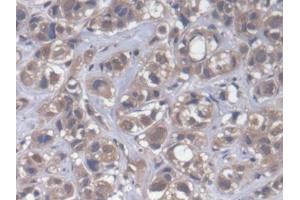DAB staining on IHC-P; Samples: Human Breast cancer Tissue (CPEB1 Antikörper  (AA 311-561))