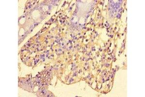 Immunohistochemistry of paraffin-embedded human colon cancer using ABIN7169823 at dilution of 1:100 (SLIT-ROBO rho GTPase Activating Protein 2C (SRGAP2C) (AA 1-242) Antikörper)