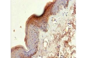 Immunohistochemistry of paraffin-embedded human skin tissue using ABIN7157440 at dilution of 1:100 (KRT6A Antikörper  (AA 305-564))