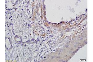 Formalin-fixed and paraffin embedded human gastric cancer labeled with Anti BMAL1 Polyclonal Antibody, Unconjugated (ABIN703571) at 1:300 followed by conjugation to the secondary antibody and DAB staining (ARNTL Antikörper  (AA 151-250))
