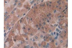 Detection of IL35 in Human Stomach cancer Tissue using Polyclonal Antibody to Interleukin 35 (IL35) (Interleukin 35 Antikörper  (AA 23-219))