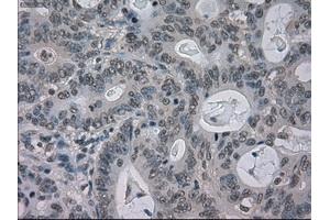 Immunohistochemical staining of paraffin-embedded Carcinoma of liver tissue using anti-BUB1Bmouse monoclonal antibody. (BUB1B Antikörper)