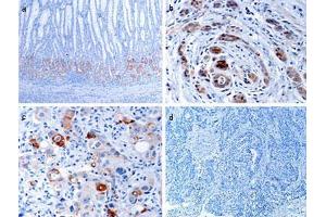 Immunohistochemical analysis of EPHB1 in human gastric cancer tissues.