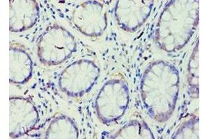 Immunohistochemistry of paraffin-embedded human colon cancer using ABIN7167947 at dilution of 1:100 (GRAF Antikörper  (AA 625-814))
