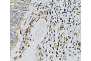 Immunohistochemistry of paraffin-embedded Human colon carcinoma using CDA Polyclonal Antibody at dilution of 1:100 (40x lens). (CDA Antikörper)