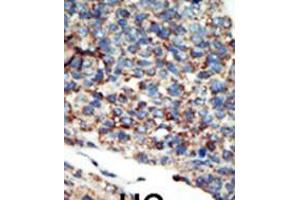 Formalin-fixed and paraffin-embedded human cancer tissue reacted with the primary antibody, which was peroxidase-conjugated to the secondary antibody, followed by AEC staining. (PI3KC2G Antikörper  (N-Term))