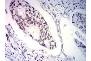 Immunohistochemical analysis of paraffin-embedded rectal cancer tissues using PGR mouse mAb with DAB staining. (Progesterone Receptor Antikörper  (AA 166-411))