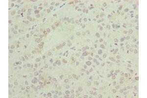 Immunohistochemistry of paraffin-embedded human liver cancer using ABIN7144721 at dilution of 1:100 (ASNSD1 Antikörper  (AA 258-357))