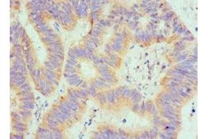 Immunohistochemistry of paraffin-embedded human colon cancer using ABIN7168895 at dilution of 1:100 (SPTLC1 Antikörper  (AA 37-310))