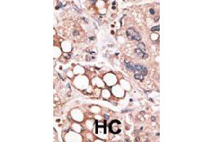 Formalin-fixed and paraffin-embedded human hepatocellular carcinoma tissue reacted with FOXO4 polyclonal antibody  , which was peroxidase-conjugated to the secondary antibody, followed by AEC staining. (FOXO4 Antikörper  (N-Term))