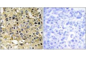 Immunohistochemistry analysis of paraffin-embedded human breast carcinoma tissue, using ENTK Antibody.