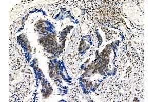 Phospho-n-Myc (Ser261/Ser263) Antibody at 1/100 staining Human colorectal cancer by IHC-P. (MYCN Antikörper  (pSer261, pSer263))