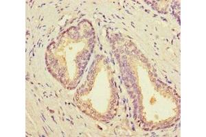 Immunohistochemistry of paraffin-embedded human prostate cancer using ABIN7161699 at dilution of 1:100 (SCP2 Antikörper  (AA 1-143))