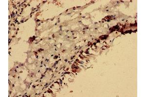 Immunohistochemistry analysis of human lung cancer using ABIN7153105 at dilution of 1:100 (FOXR2 Antikörper  (AA 1-300))