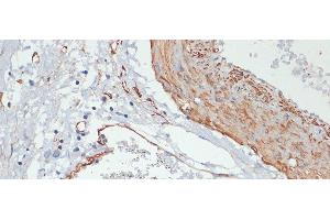 Immunohistochemistry of paraffin-embedded Human gastric cancer using Phospho-MYL9(T18/S19) Polyclonal Antibody at dilution of 1:100 (40x lens).