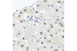 Immunohistochemistry of paraffin-embedded human breast carcinoma using UBC antibody. (UBC Antikörper  (AA 1-100))