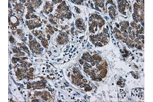 Immunohistochemical staining of paraffin-embedded Carcinoma of liver tissue using anti-ATP5B mouse monoclonal antibody. (ATP5B Antikörper)