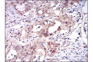 Immunohistochemical analysis of paraffin-embedded human cervical cancer tissues using ONECUT3 mouse mAb with DAB staining.
