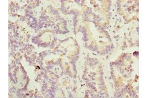 Immunohistochemistry of paraffin-embedded human lung cancer using ABIN7169185 at dilution of 1:100 (SIK3 Antikörper  (AA 60-310))
