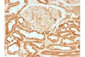 IHC testing of FFPE human renal cell carcinoma with Calnexin antibody. (Calnexin Antikörper)