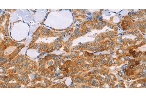 Immunohistochemistry of paraffin-embedded Human thyroid cancer tissue using CARD6 Polyclonal Antibody at dilution 1:60 (CARD6 Antikörper)