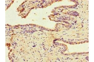 Immunohistochemistry of paraffin-embedded human prostate cancer using ABIN7159790 at dilution of 1:100