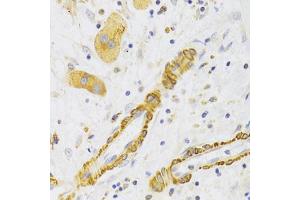 Immunohistochemistry of paraffin-embedded human liver cancer using KIF1B Antibody (ABIN2563552) at dilution of 1:100 (40x lens). (KIF1B Antikörper)