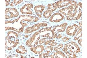 Formalin-fixed, paraffin-embedded human Prostate stained with ODC1 Rabbit Recombinant Monoclonal Antibody (ODC1/2878R). (Rekombinanter ODC1 Antikörper)