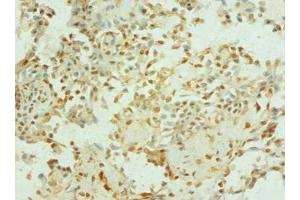 Immunohistochemistry of paraffin-embedded human breast cancer using  at dilution of 1: 100 (TEP1 Antikörper  (AA 2-226))