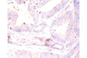 Immunohistochemistry of paraffin-embedded human colon cancer using ABIN7142829 at diluton of 1:50 (RPL5 Antikörper  (AA 2-297))