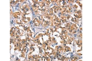 Immunohistochemistry of Human gastric cancer using HGF Polyclonal Antibody at dilution of 1:65