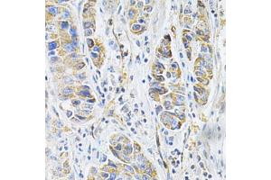 Immunohistochemistry of paraffin-embedded human liver cancer using VAPB Antibody (ABIN1876551) at dilution of 1:200 (40x lens). (VAPB Antikörper)