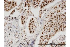 Immunoperoxidase of monoclonal antibody to PBK on formalin-fixed paraffin-embedded human cholangiocarcinoma. (PBK Antikörper  (AA 1-30))