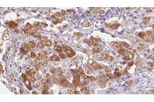 ABIN6279753 at 1/100 staining Human liver cancer tissue by IHC-P. (PTPRK Antikörper  (Internal Region))