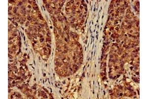 Immunohistochemistry of paraffin-embedded human ovarian cancer using ABIN7151428 at dilution of 1:100 (EFHD2 Antikörper  (AA 2-240))