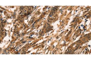 Immunohistochemistry of paraffin-embedded Human gastric cancer tissue using CD159a/c Polyclonal Antibody at dilution 1:30 (CD159a/c Antikörper)