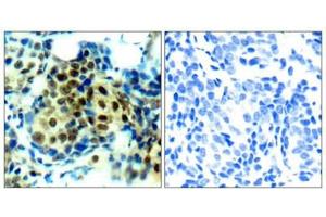 Immunohistochemical analysis of paraffin-embedded human breast carcinoma tissue using p44/42 MAP Kinase (Phospho-Thr202) Antibody (left) or the same antibody preincubated with blocking peptide (right). (ERK1 Antikörper  (pThr202))