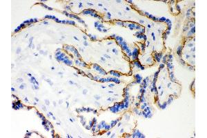 Immunohistochemistry (Paraffin-embedded Sections) (IHC (p)) image for anti-Cadherin 1, Type 1, E-Cadherin (Epithelial) (CDH1) (AA 286-703) antibody (ABIN3043808) (E-cadherin Antikörper  (AA 286-703))