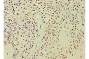 Immunohistochemistry of paraffin-embedded human breast cancer using ABIN7143446 at dilution of 1:100 (ARF3 Antikörper  (AA 1-181))