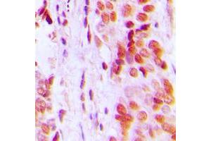 Immunohistochemical analysis of p57 Kip2 staining in human breast cancer formalin fixed paraffin embedded tissue section. (CDKN1C Antikörper  (N-Term))