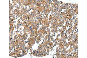 Immunohistochemistry of Human cervical cancer using CXCL12 Polyclonal Antibody at dilution of 1:40 (CXCL12 Antikörper)